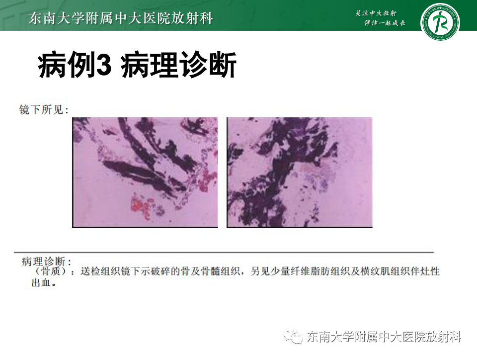 影像PPT - 【PPT】多发性骨髓瘤的影像诊断-24 影像PPT - 【PPT】多发性骨髓瘤的影像诊断-24