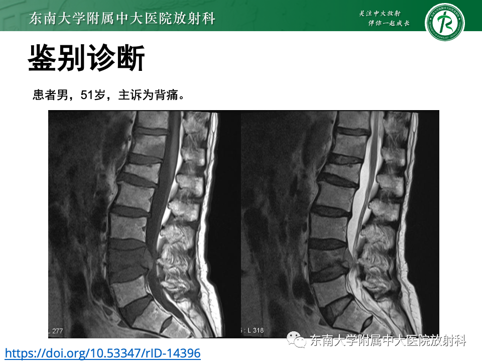 影像PPT - 【PPT】多发性骨髓瘤的影像诊断-29 影像PPT - 【PPT】多发性骨髓瘤的影像诊断-29