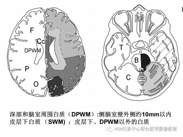 影像PPT - 【PPT】非血管因素弥漫性脑白质病的MRI鉴别诊断-9