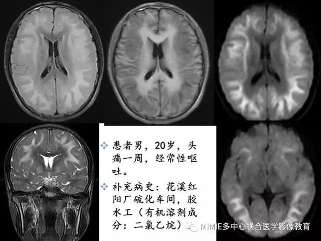影像PPT - 【PPT】非血管因素弥漫性脑白质病的MRI鉴别诊断-11