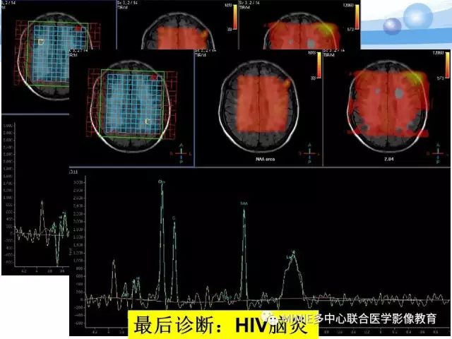 影像PPT - 【PPT】非血管因素弥漫性脑白质病的MRI鉴别诊断-14