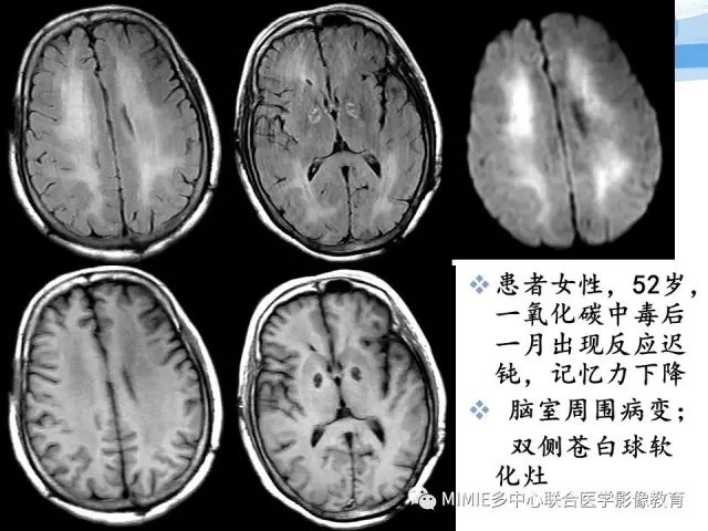 影像PPT - 【PPT】非血管因素弥漫性脑白质病的MRI鉴别诊断-12