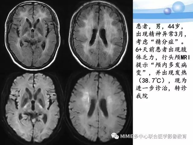 影像PPT - 【PPT】非血管因素弥漫性脑白质病的MRI鉴别诊断-13