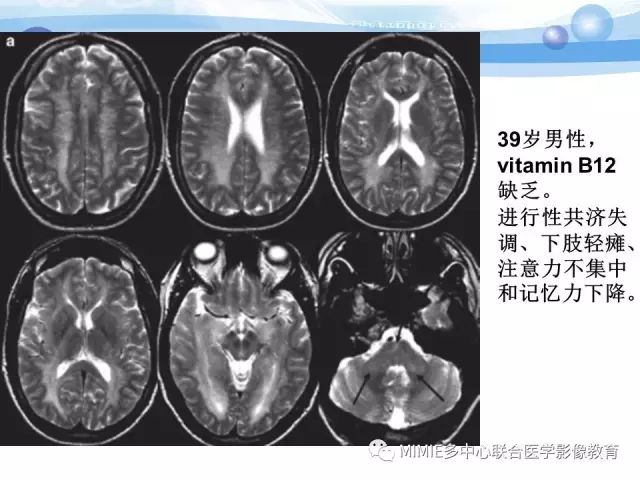 影像PPT - 【PPT】非血管因素弥漫性脑白质病的MRI鉴别诊断-15