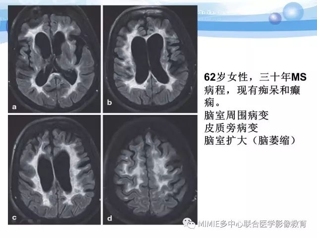 影像PPT - 【PPT】非血管因素弥漫性脑白质病的MRI鉴别诊断-17