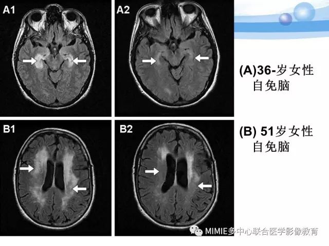 影像PPT - 【PPT】非血管因素弥漫性脑白质病的MRI鉴别诊断-19