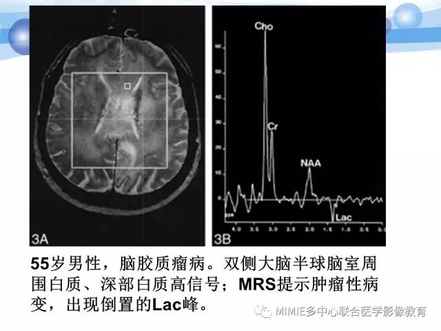 影像PPT - 【PPT】非血管因素弥漫性脑白质病的MRI鉴别诊断-20