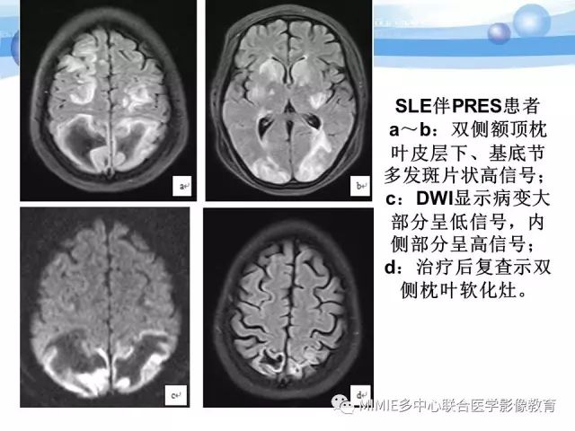 影像PPT - 【PPT】非血管因素弥漫性脑白质病的MRI鉴别诊断-18