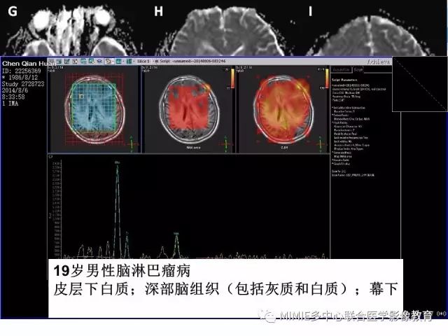 影像PPT - 【PPT】非血管因素弥漫性脑白质病的MRI鉴别诊断-22