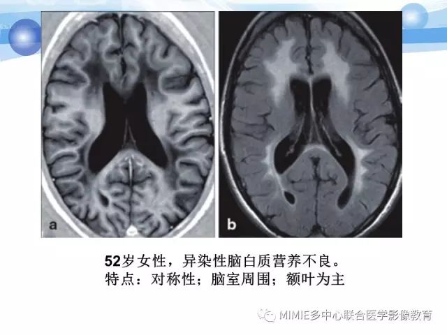 影像PPT - 【PPT】非血管因素弥漫性脑白质病的MRI鉴别诊断-24