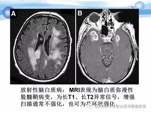 影像PPT - 【PPT】非血管因素弥漫性脑白质病的MRI鉴别诊断-25