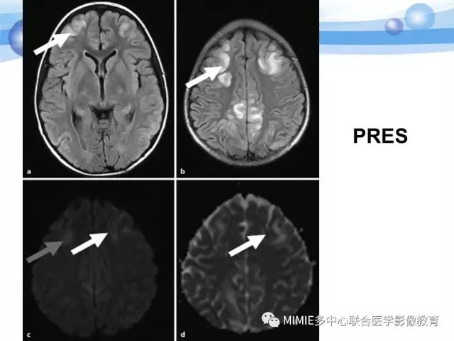 影像PPT - 【PPT】非血管因素弥漫性脑白质病的MRI鉴别诊断-27
