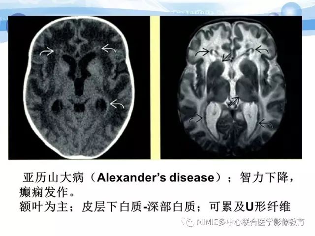 影像PPT - 【PPT】非血管因素弥漫性脑白质病的MRI鉴别诊断-30