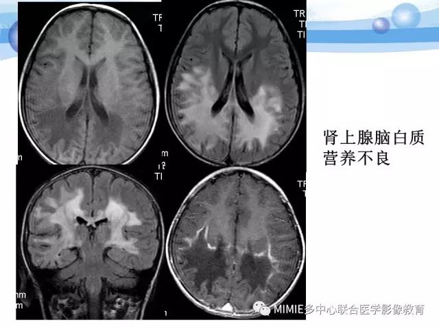 影像PPT - 【PPT】非血管因素弥漫性脑白质病的MRI鉴别诊断-32