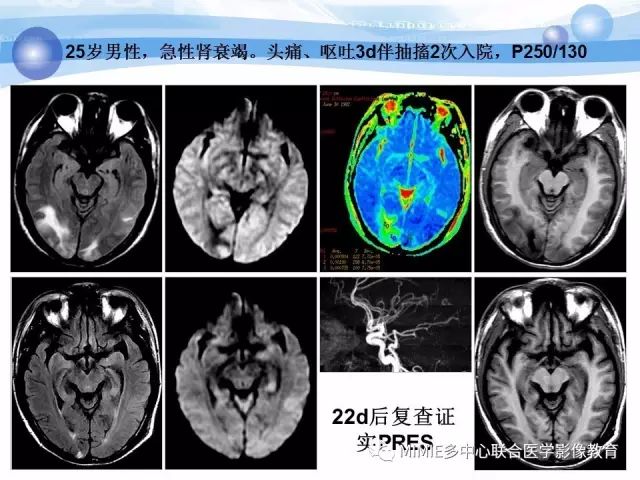 影像PPT - 【PPT】非血管因素弥漫性脑白质病的MRI鉴别诊断-33