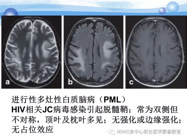 影像PPT - 【PPT】非血管因素弥漫性脑白质病的MRI鉴别诊断-34