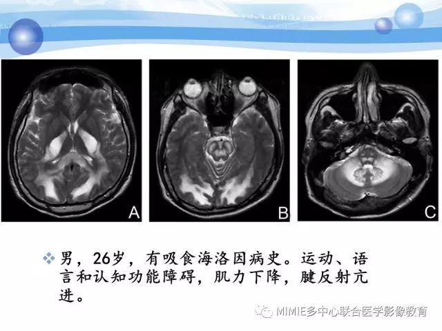 影像PPT - 【PPT】非血管因素弥漫性脑白质病的MRI鉴别诊断-35