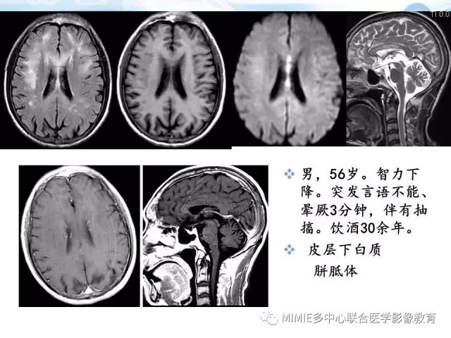 影像PPT - 【PPT】非血管因素弥漫性脑白质病的MRI鉴别诊断-37