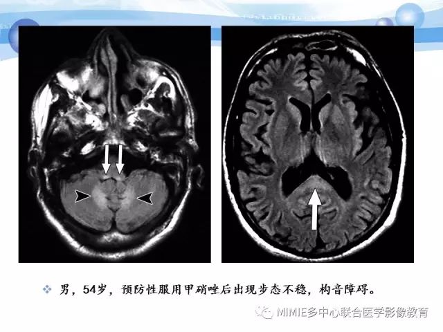 影像PPT - 【PPT】非血管因素弥漫性脑白质病的MRI鉴别诊断-39
