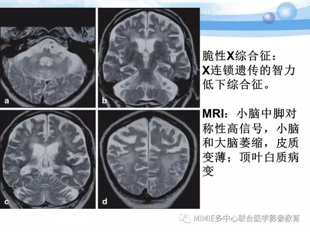 影像PPT - 【PPT】非血管因素弥漫性脑白质病的MRI鉴别诊断-42