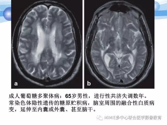 影像PPT - 【PPT】非血管因素弥漫性脑白质病的MRI鉴别诊断-40