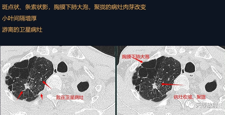 影像PPT - 【病例】肺结核典型CT病例分析-10 影像PPT - 【病例】肺结核典型CT病例分析-10