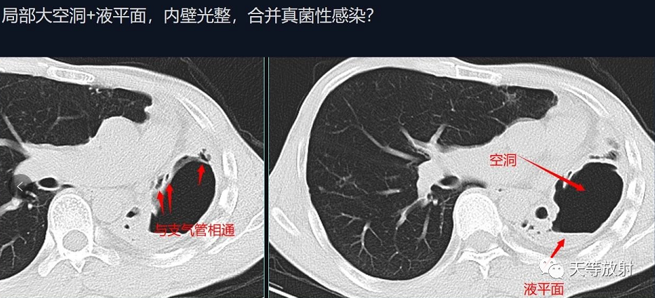 影像PPT - 【病例】肺结核典型CT病例分析-11 影像PPT - 【病例】肺结核典型CT病例分析-11