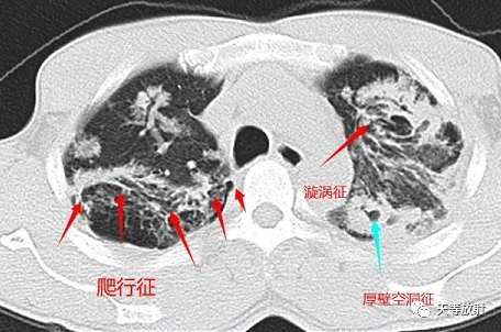 影像PPT - 【病例】肺结核典型CT病例分析-12 影像PPT - 【病例】肺结核典型CT病例分析-12