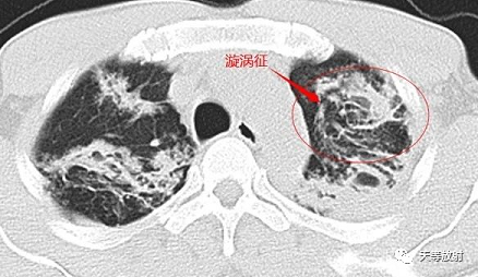 影像PPT - 【病例】肺结核典型CT病例分析-13 影像PPT - 【病例】肺结核典型CT病例分析-13