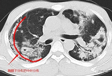 影像PPT - 【病例】肺结核典型CT病例分析-14 影像PPT - 【病例】肺结核典型CT病例分析-14