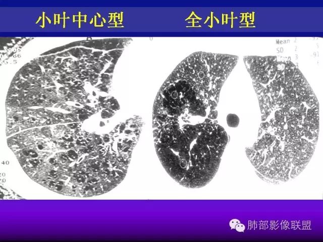 影像PPT - 【PPT 】弥漫性低密度肺疾病-3