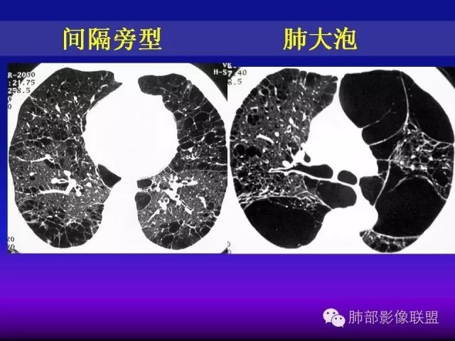 影像PPT - 【PPT 】弥漫性低密度肺疾病-4