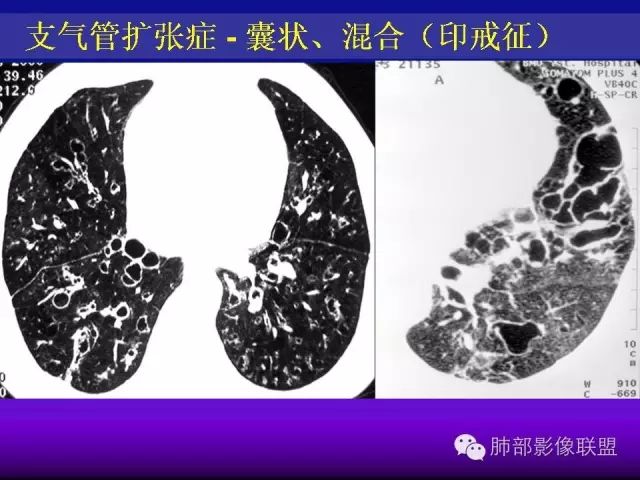 影像PPT - 【PPT 】弥漫性低密度肺疾病-5