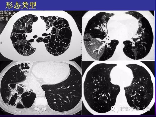 影像PPT - 【PPT 】弥漫性低密度肺疾病-6