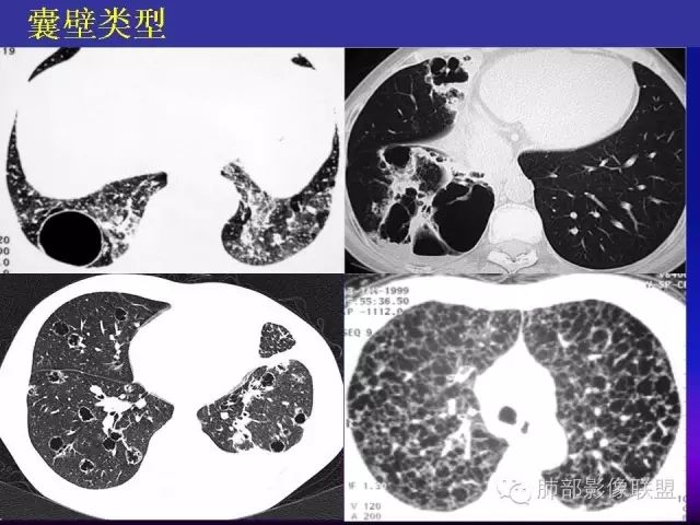 影像PPT - 【PPT 】弥漫性低密度肺疾病-14