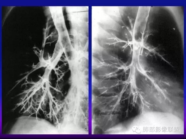 影像PPT - 【PPT 】弥漫性低密度肺疾病-21