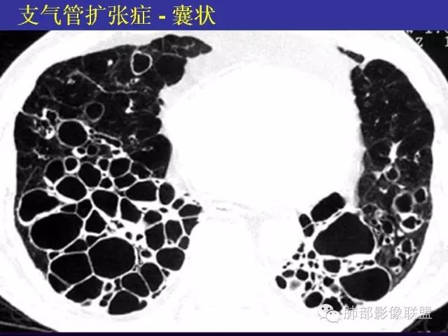 影像PPT - 【PPT 】弥漫性低密度肺疾病-25