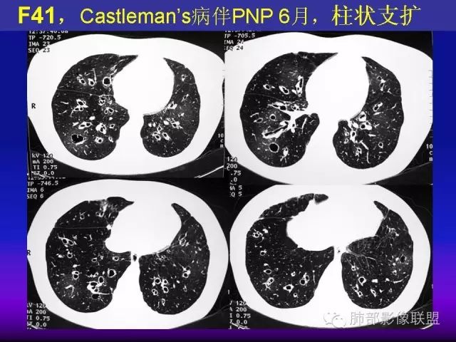 影像PPT - 【PPT 】弥漫性低密度肺疾病-24