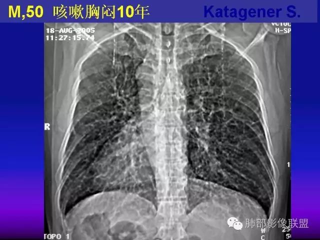 影像PPT - 【PPT 】弥漫性低密度肺疾病-28