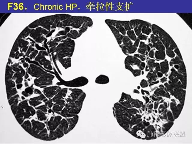 影像PPT - 【PPT 】弥漫性低密度肺疾病-30