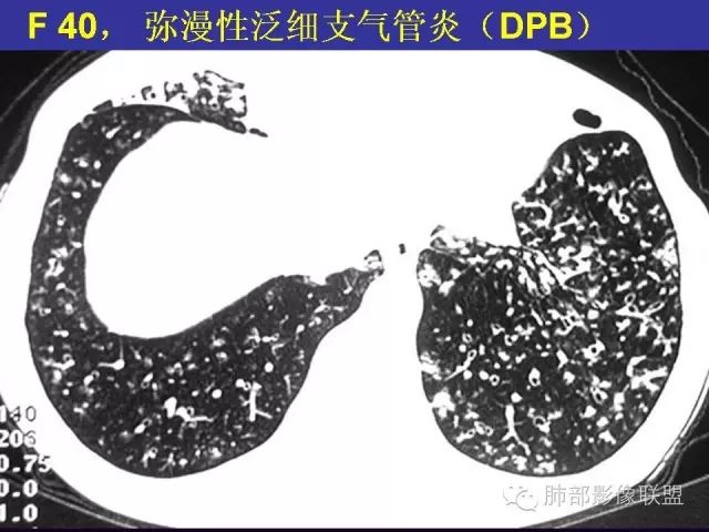 影像PPT - 【PPT 】弥漫性低密度肺疾病-35