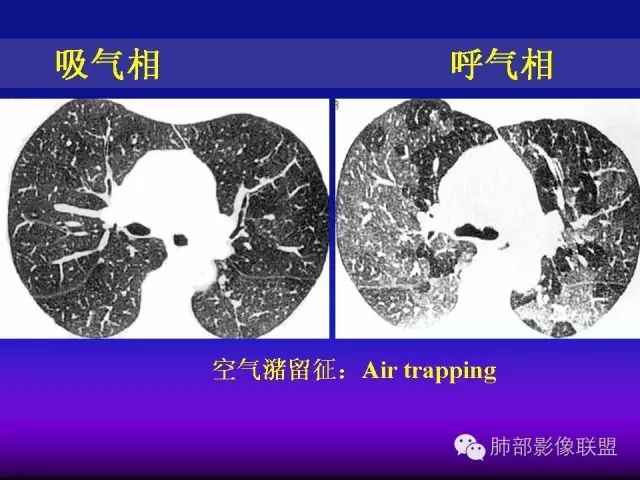 影像PPT - 【PPT 】弥漫性低密度肺疾病-38