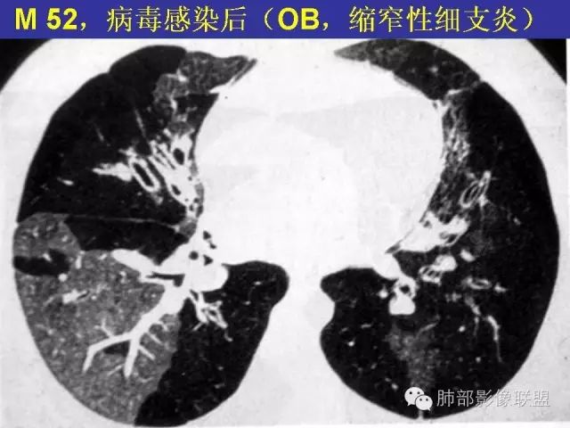 影像PPT - 【PPT 】弥漫性低密度肺疾病-39