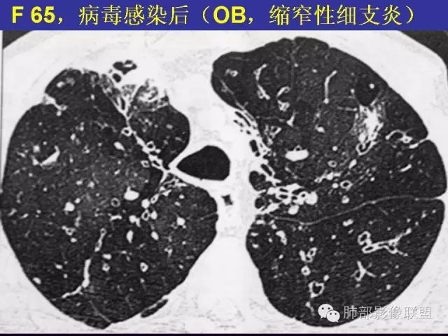 影像PPT - 【PPT 】弥漫性低密度肺疾病-40