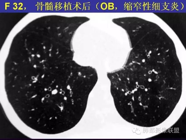 影像PPT - 【PPT 】弥漫性低密度肺疾病-41
