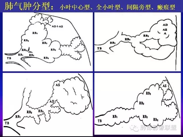 影像PPT - 【PPT 】弥漫性低密度肺疾病-45