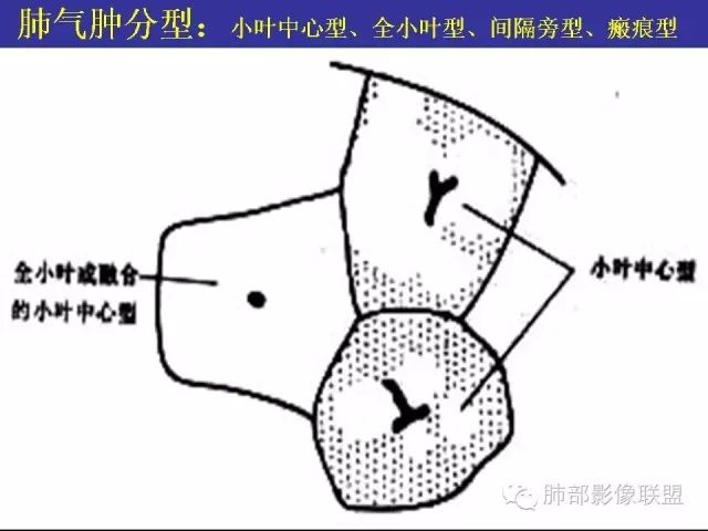 影像PPT - 【PPT 】弥漫性低密度肺疾病-46
