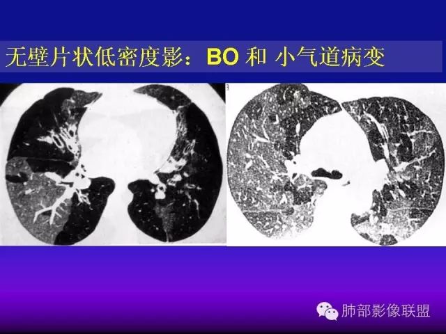 影像PPT - 【PPT 】弥漫性低密度肺疾病-47