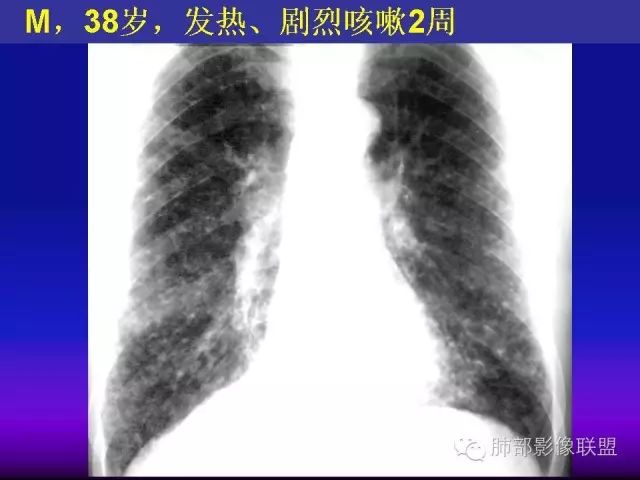 影像PPT - 【PPT 】弥漫性低密度肺疾病-33