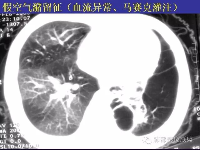 影像PPT - 【PPT 】弥漫性低密度肺疾病-48